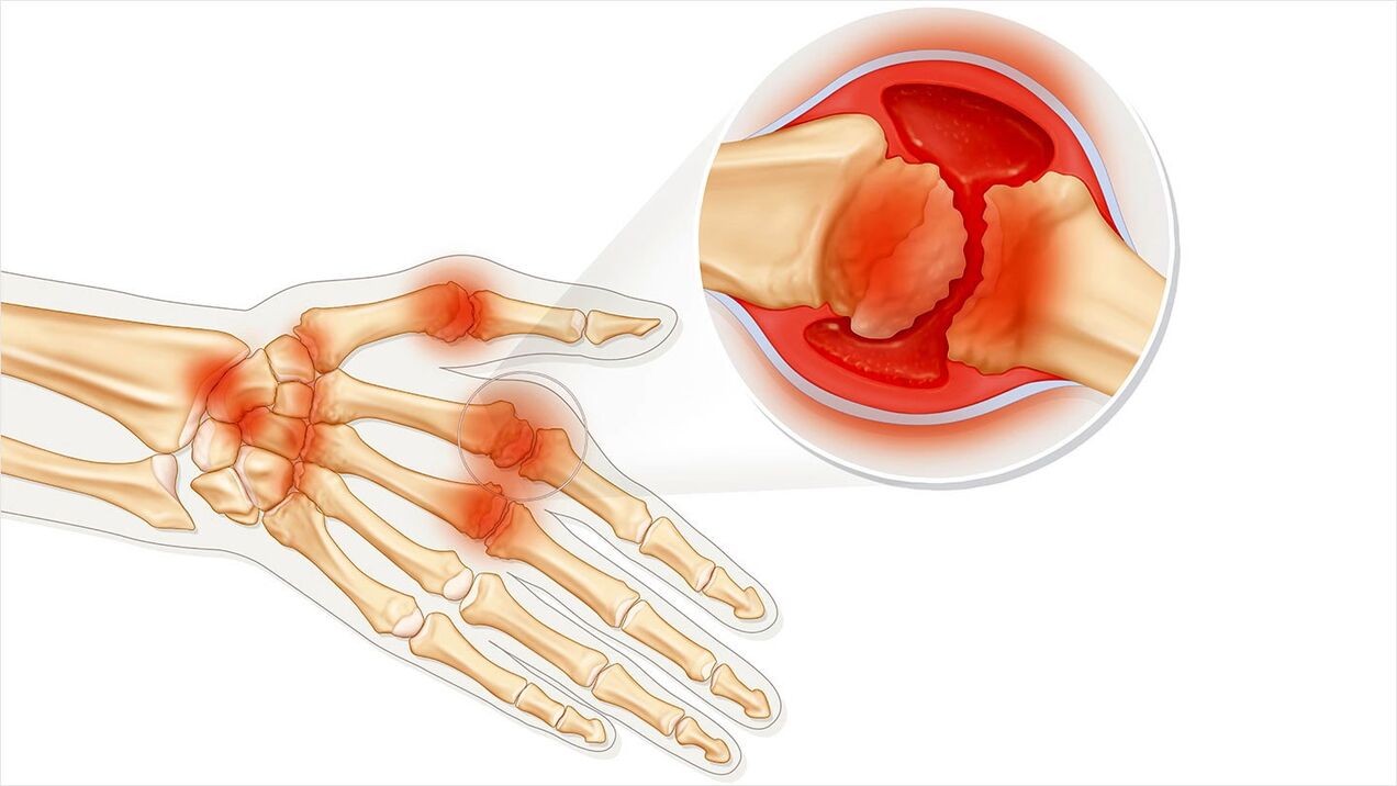 Arthrosis to be treated with Traugel