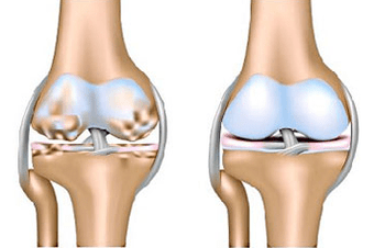 Healthy joint and arthrosis