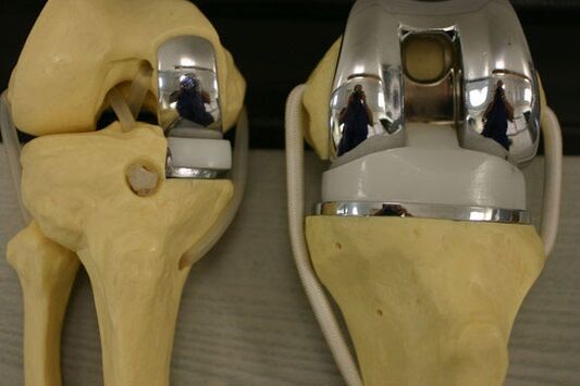 Endoprostic options of knee combination