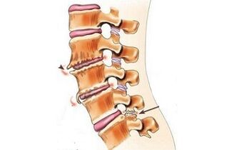 Spondylartrosis such as causes of back pain