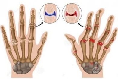 Causes of pain in the joints of fingers