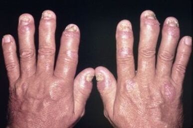 Why do the joints of fingers hurt