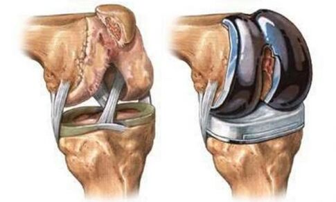 Endoprostetics of knee joint for arthros