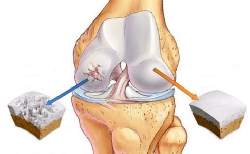 Healthy combination of knee joint and arthrosis