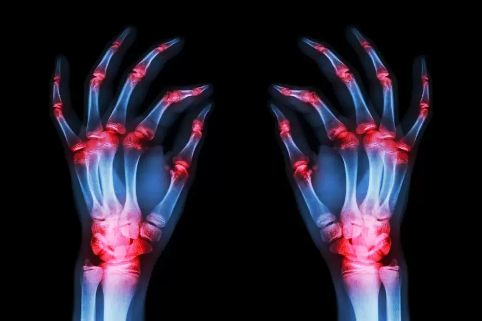 arthrosis of finger joints